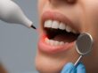 Dental laser gently treating gum tissue